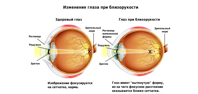 схема глаза при миопии